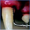 periodontal probe