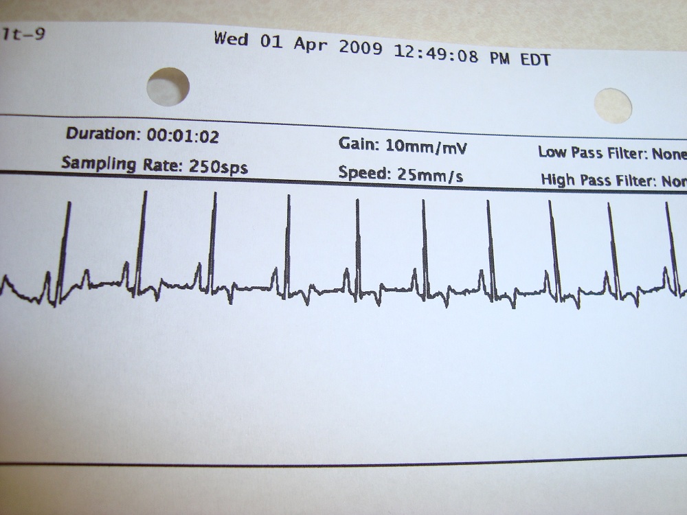 EKG Results