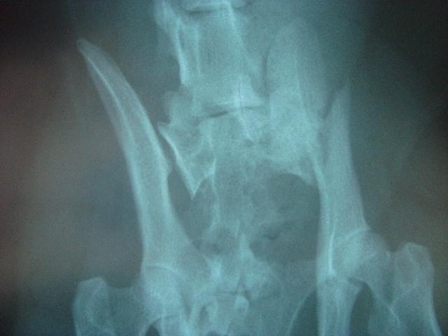 Fractured Pelvis