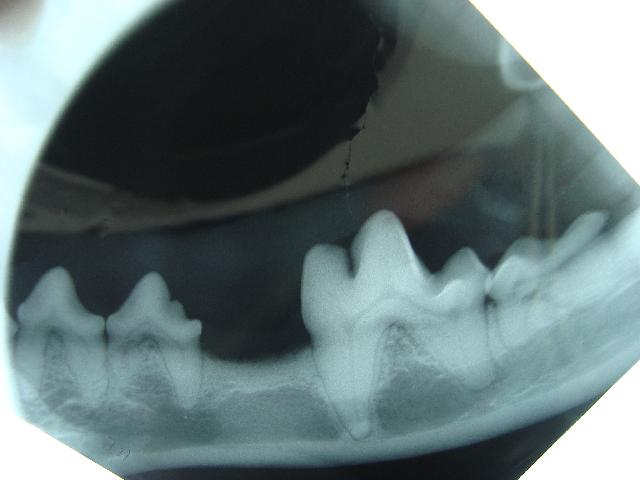 Missing Tooth on X-ray